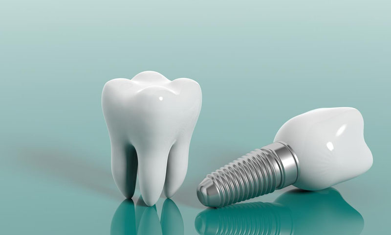 Implant Treatment