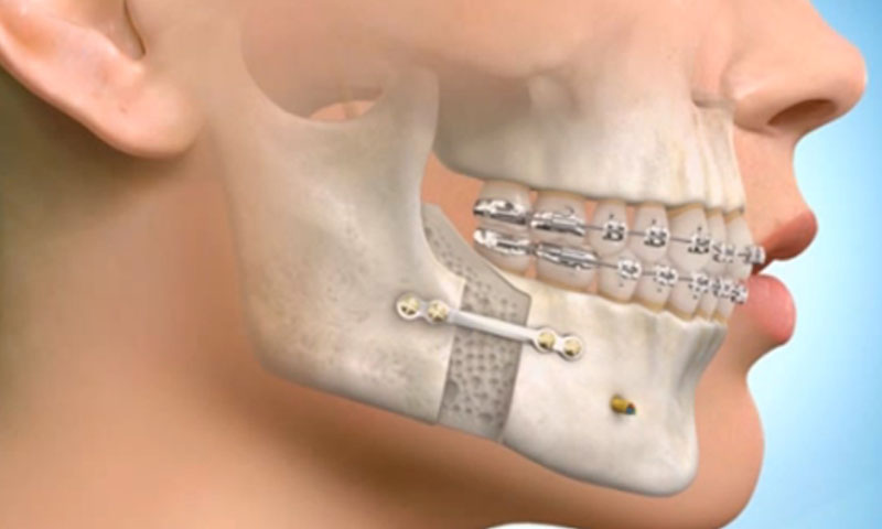 Jaw surgery