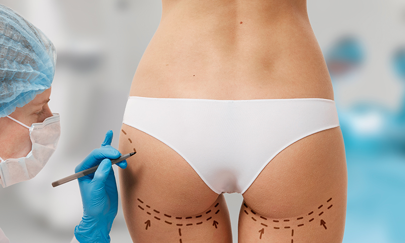 Liposuction